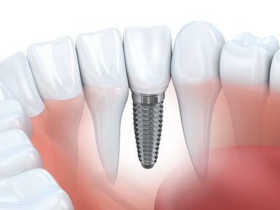 How dental implants function?